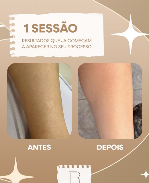 Antes e depois de depilação a laser com apenas uma sessão